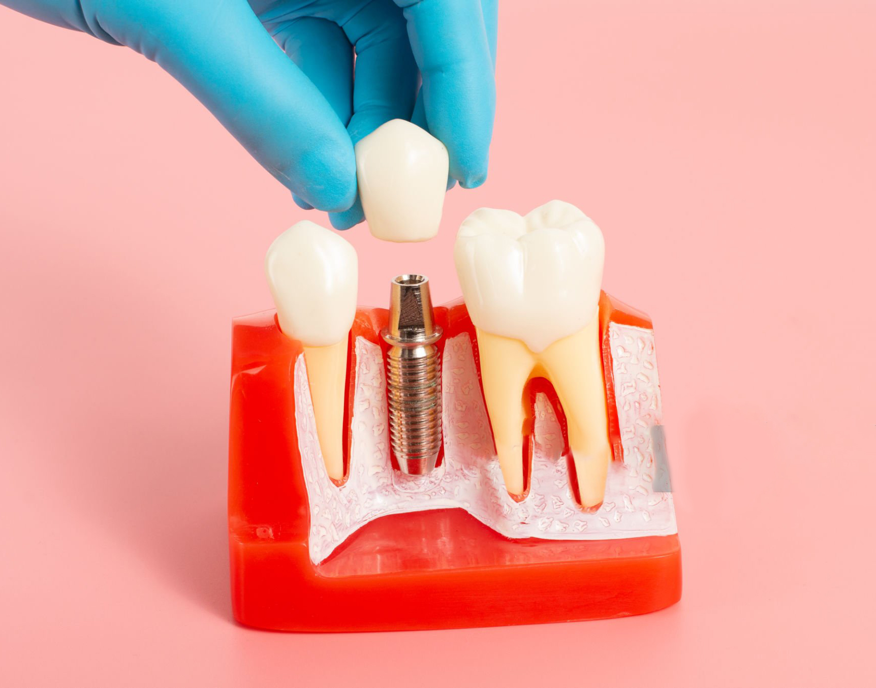 Dental Implants burlington