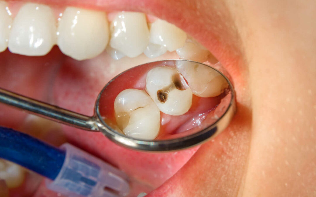 A dentist using a mouth mirror to reveal cavity in a patient's tooth.