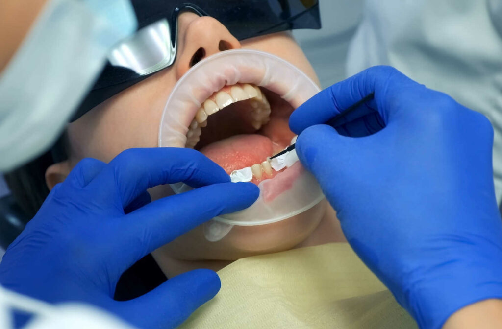 A close-up of a patient with an open mouth and a dentist's hands applying a special cement to a patient's teeth before placing the veneers on.