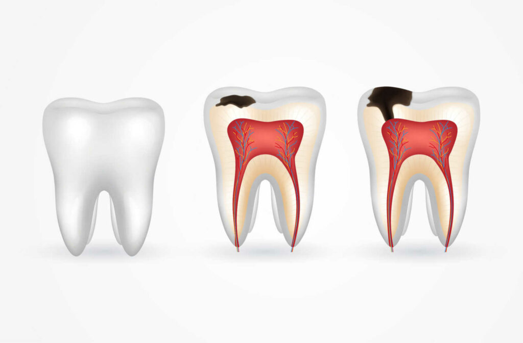 An illustration of how tooth cavities occur and cause tooth decay. 